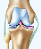 Proth�se de genou : questions